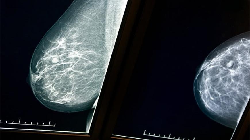 xray breast tissue risperdal